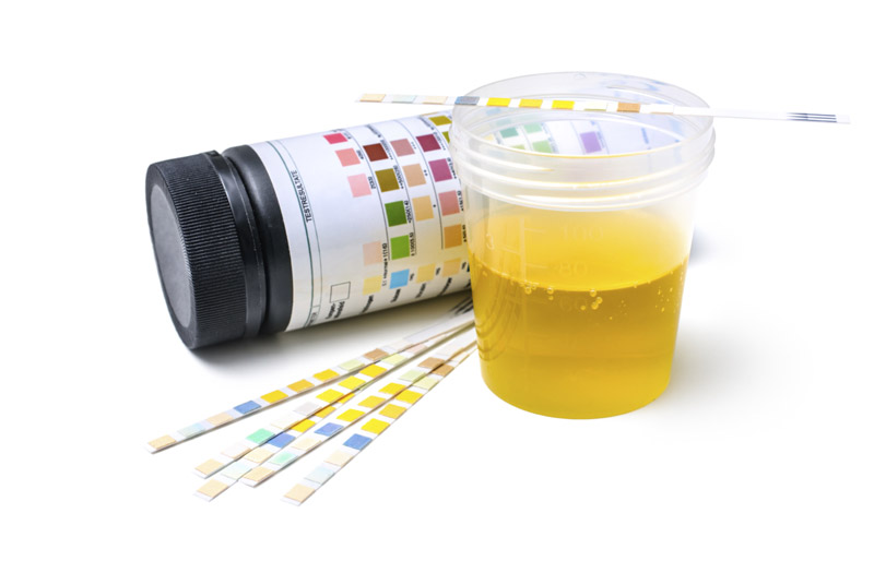 Urine Testing in Recovery